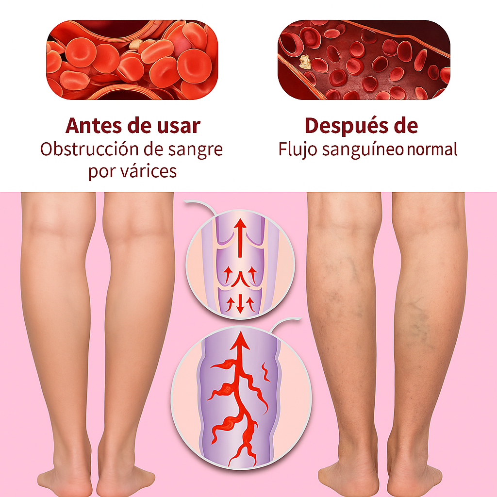 CREMA PARA VARICES - ALIVIO SEGURO
