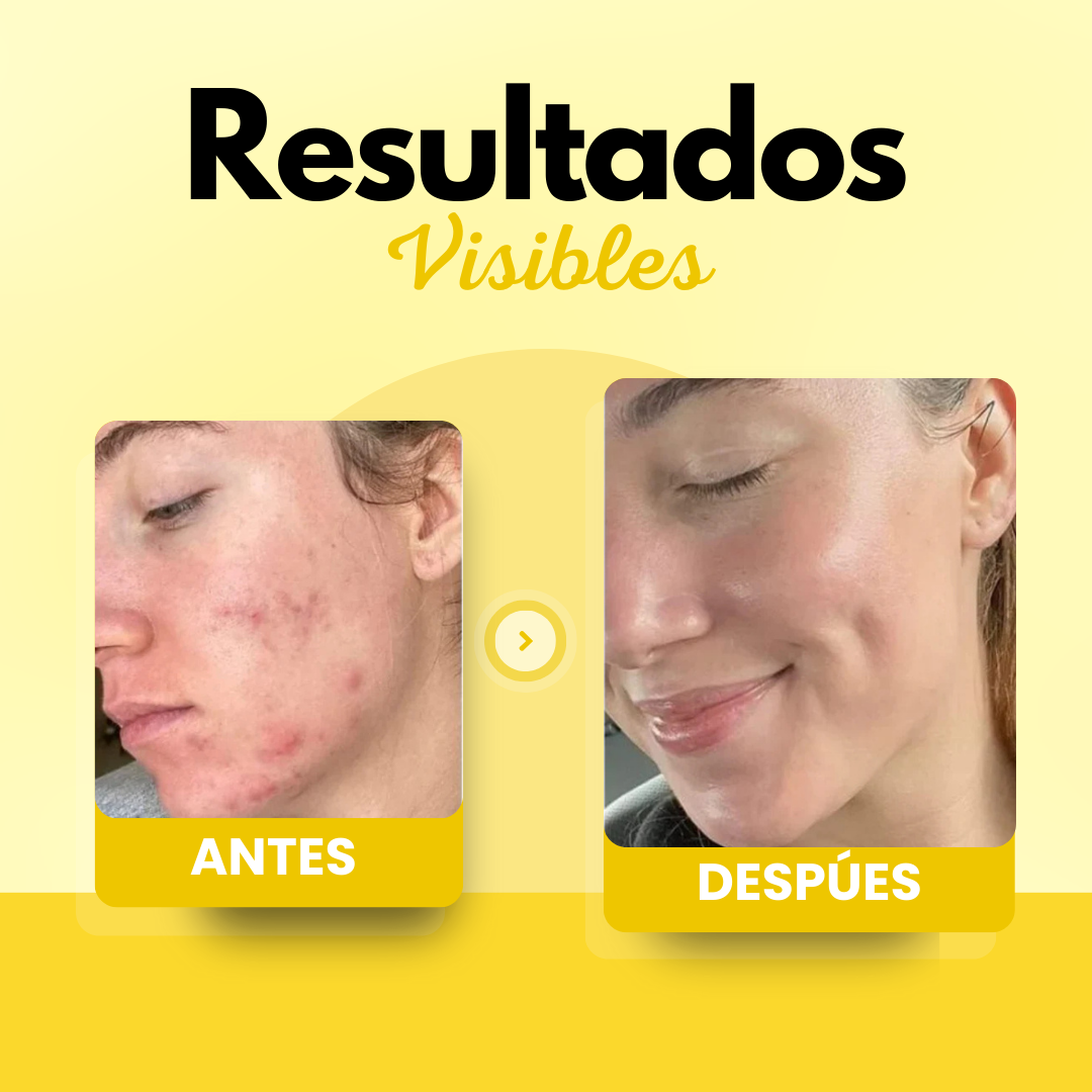 CREMA FACIAL CON SEBO DE RES Y MIEL - PARA PIEL SECA Y CON ACNÉ